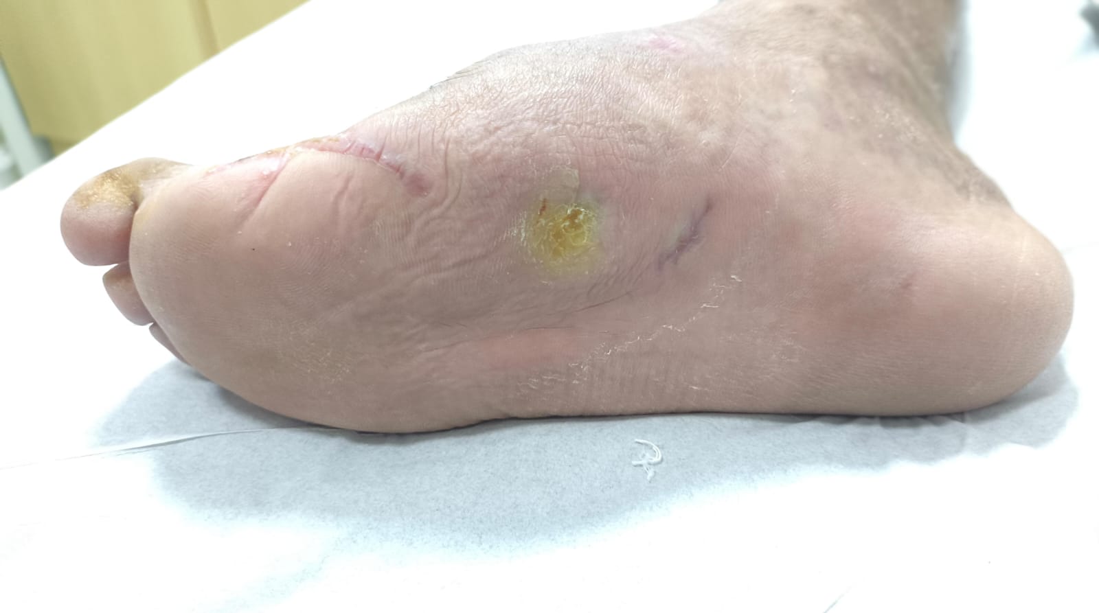 Foto antes do tratamento: Mal perfurante plantar em paciente diabético